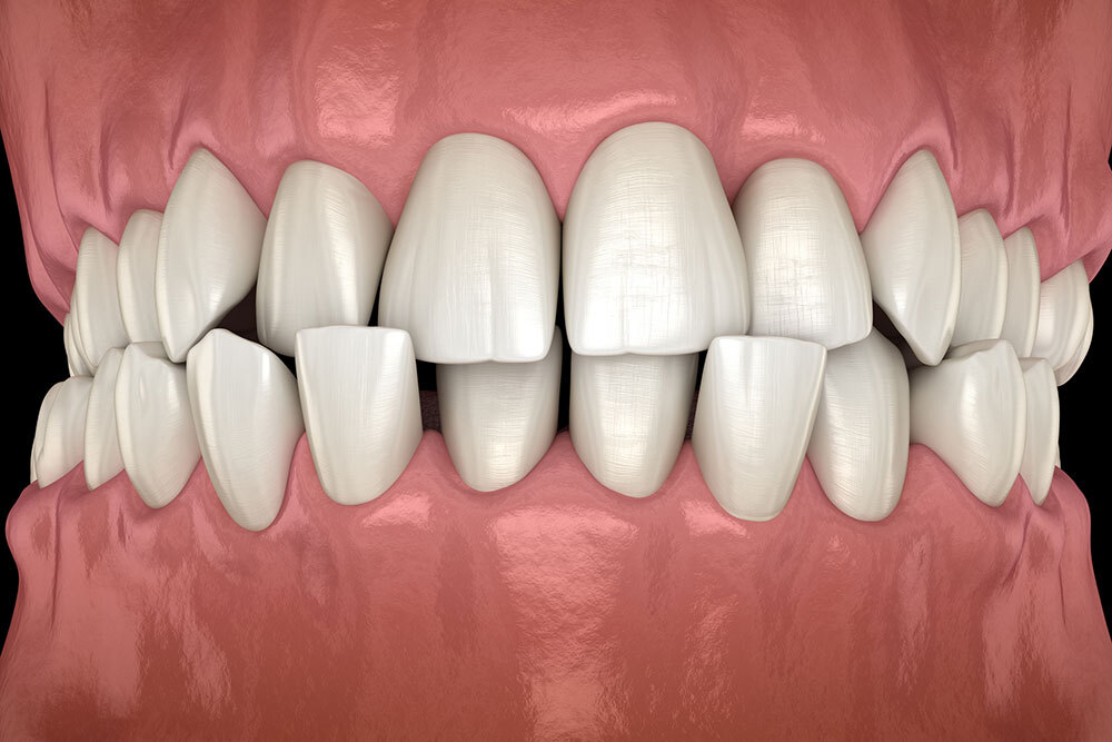 ocluzie dentara